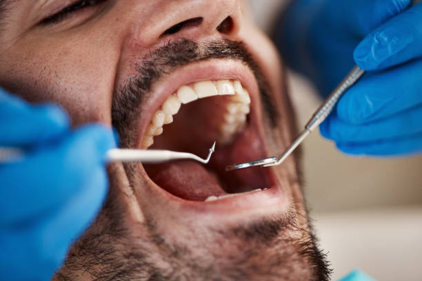 Best Emergency Dentist for Lost Fillings or Crowns in Stewart Manor, NY